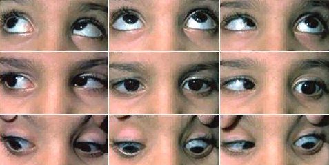 DRS, Type III patient